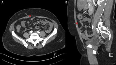 Interdisciplinary Treatment of Breast Cancer After Mastectomy With Autologous Breast Reconstruction Using Abdominal Free Flaps in a University Teaching Hospital—A Standardized and Safe Procedure